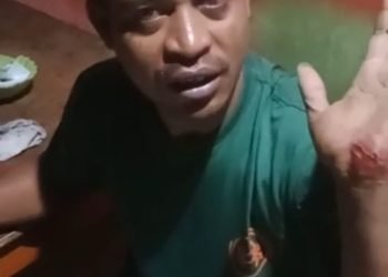 Damianus Deufester Wae, korban begal yang selamat menunjukan telapak tangannya yang luka saat lompat dari motor, Kamis 7 Desember 2023. (Foto : Ist./Koranpapua.id)