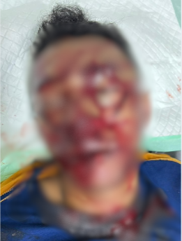 Honorer Dinas Pendidikan Alami Kecelakaan Ganda, Bukan Dianiaya OTK